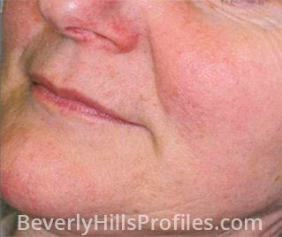 Rosacea After Treatment Photo: female face, oblique view, patient 1