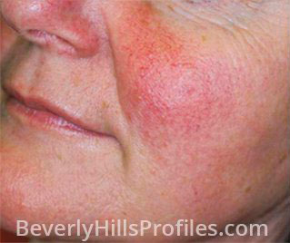 Rosacea Before Treatment Photo: female face, oblique view, patient 1