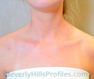 Sun Damage After Treatment Photo: female patient, front view