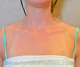 Sun Damage Before Treatment Photo: female patient, front view