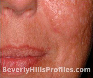 Female face, before SURGICAL SCARS REMOVAL Treatment