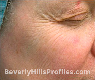 Female face before PALOMAR ICON XD AESTHETICS treatment, right cheek