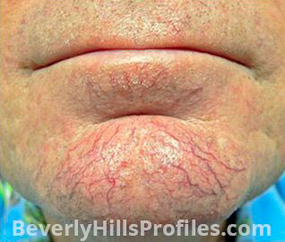 Facial Vessels and Pigments Before Treatment Photo Gallery - male, front view, patient 1