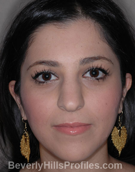 Ethnic Rhinoplasty - Before Treatment photo, female face, front view, patient 1