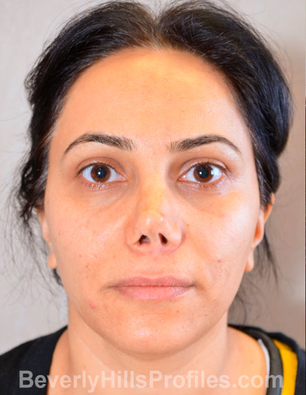 arabic female patient, front view