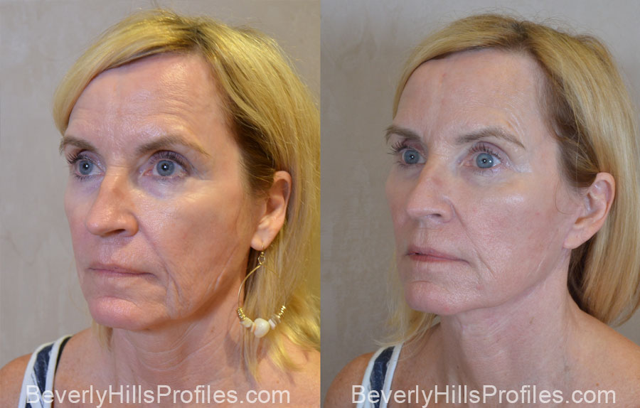 Facelift Before and After Photo Gallery - female, oblique view, patient 13