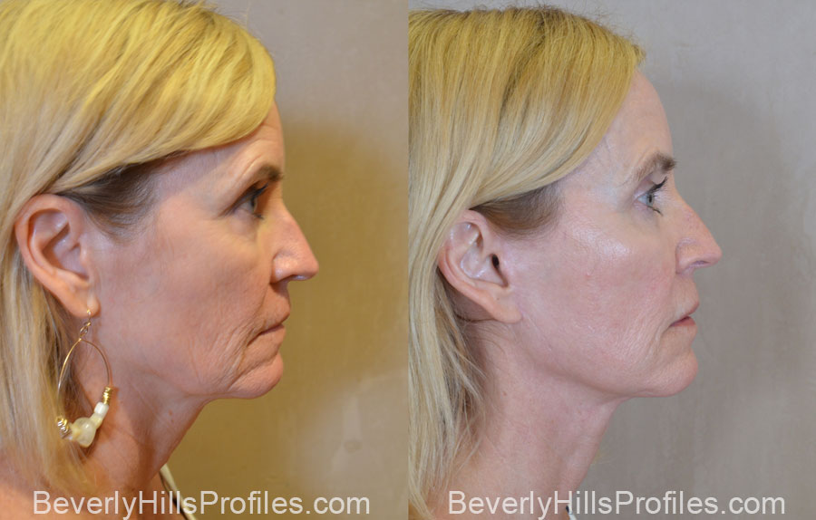 Facelift Before and After - old female, right side view
