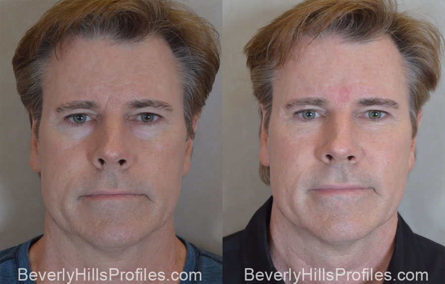 Facial Fat Transfer Before and After Photo Gallery - male, front view,patient 17