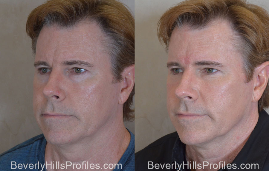 Facial Fat Transfer Before and After Photo Gallery - male, oblique view