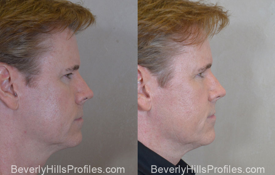 Facial Fat Transfer Before and After Photo Gallery - male, side view