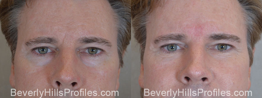 Facial Fat Transfer Before and After Photo Gallery - male, front view