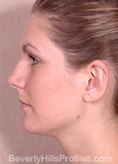 Otoplasty After - female, side view