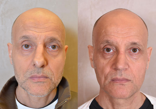 Revision Rhinoplasty Before and After Photo - male, front view