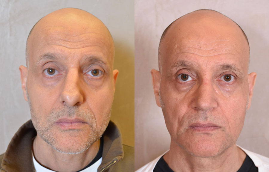 Revision Rhinoplasty Before and After Photo Gallery - male, front view