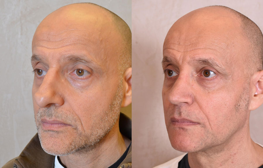 Revision Rhinoplasty Before and After Photo - male, oblique view