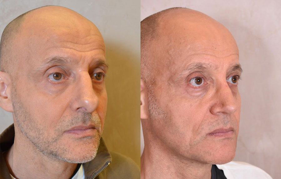 Revision Rhinoplasty Before and After Photo - male, right oblique view