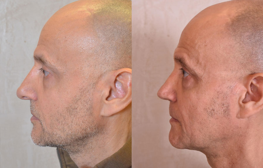 Revision Rhinoplasty Before and After Photo - male, side view