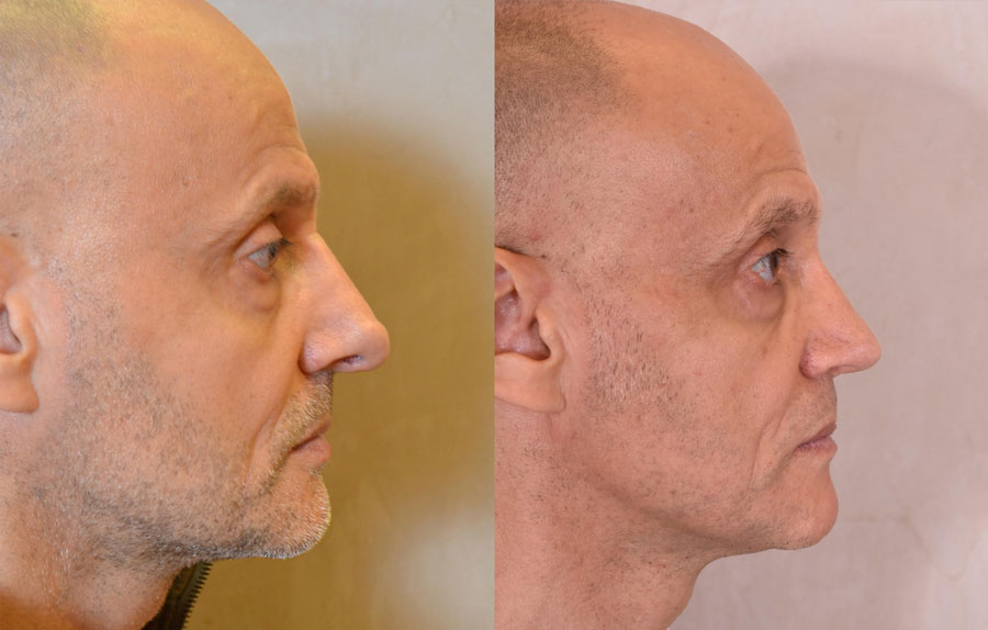 Revision Rhinoplasty Before and After Photo - male, right side view