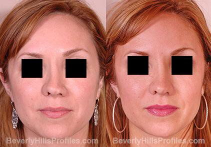 Revision Rhinoplasty Before and After Photo - female, front view