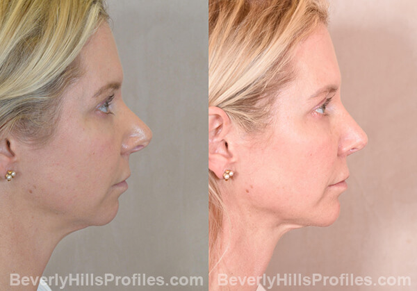 Chin Implants Before & After Photos - profile view