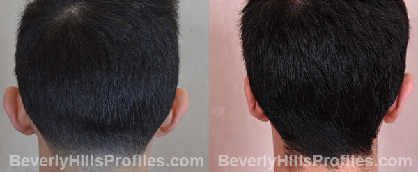 Otoplasty Before and After Photo Gallery - male, back view