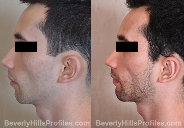 Otoplasty Before and After Photo Gallery - male, side view