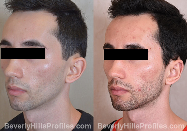 Otoplasty Before and After Photo Gallery - male, oblique view