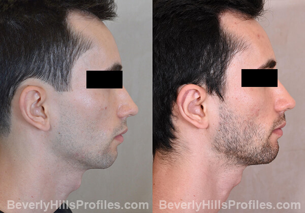 Otoplasty Before and After Photo Gallery - male, right side view
