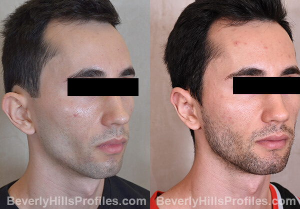 Otoplasty Before and After Photo Gallery - male, right oblique view