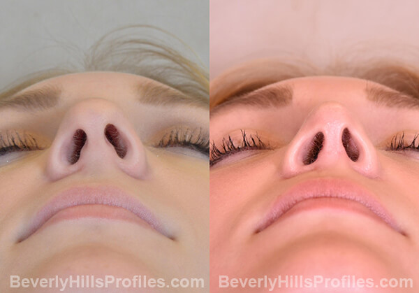 Nose Job Before and After Photo Gallery - female, bottom view