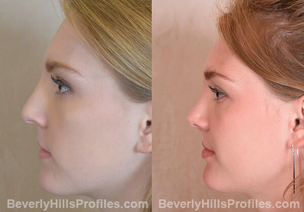 Nose Job Before and After Photo Gallery - female, side view