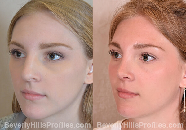 Nose Job Before and After Photo Gallery - female, oblique view