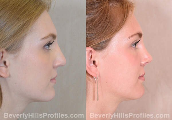 Nose Job Before and After Photo Gallery - female, right side view