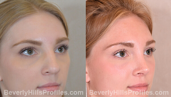 Nose Job Before and After Photo Gallery - female, right oblique view