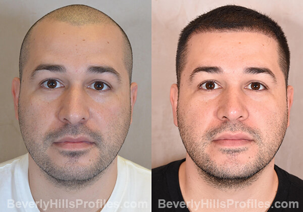 Nose Job Before After - male, front view
