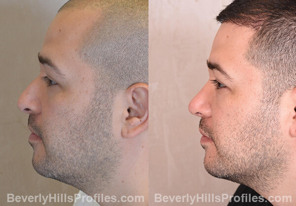 Nose Job Before After - male, side view