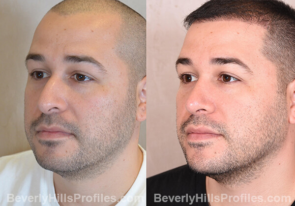 Nose Job Before After - male, oblique view
