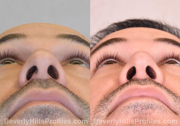 Nose Job Before After - male, bottom view