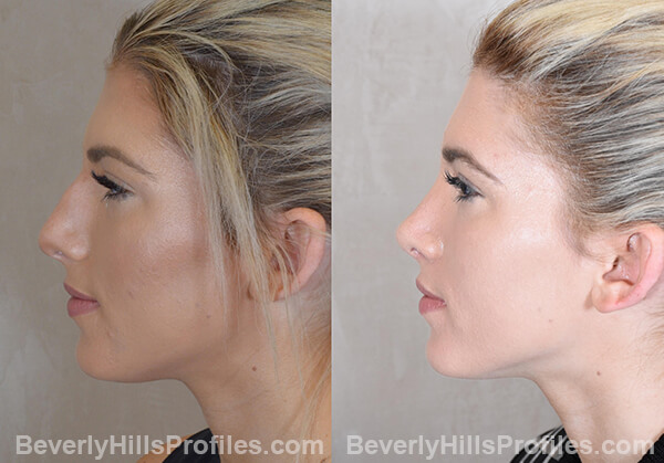 Nose Job Before and After Photo - female, side view
