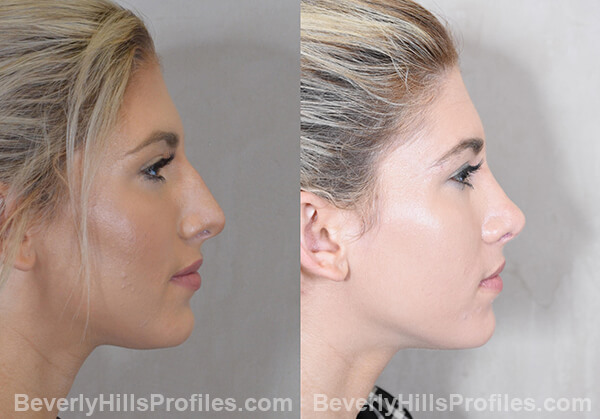 Nose Job Before and After Photo - female, right side view