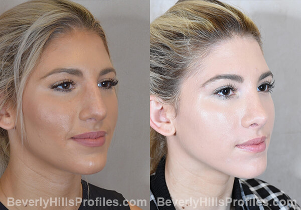 Nose Job Before and After Photo - female, oblique view