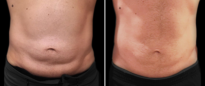 SculpSure Before and After Photos: male, front view, patient 1