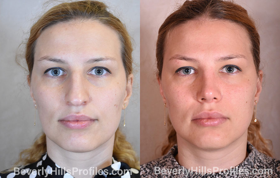 Woman's face, before and after Rhinoplasty treatment, front view, patient 110