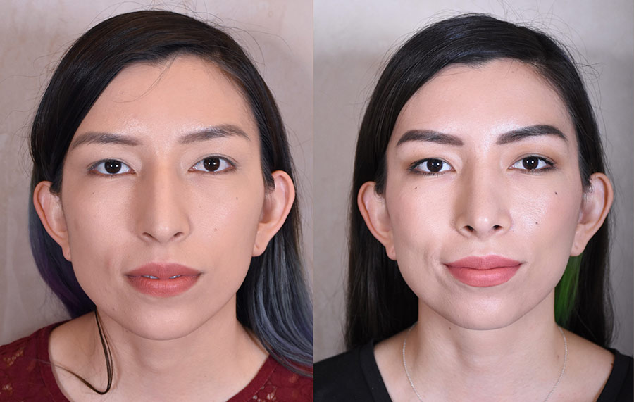 Woman's face, before and after Rhinoplasty treatment, front view, patient 11