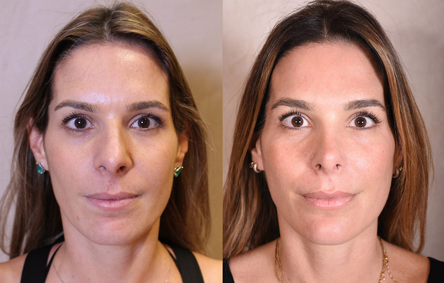 Woman's face, before and after Rhinoplasty treatment, front view, patient 21