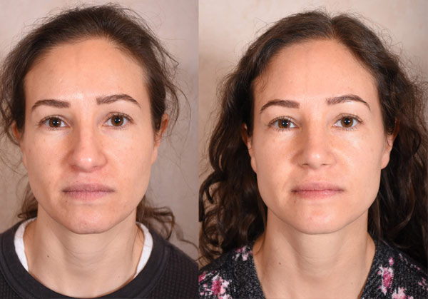 Revision Rhinoplasty Before and After Photo Gallery - front view, female patient 38