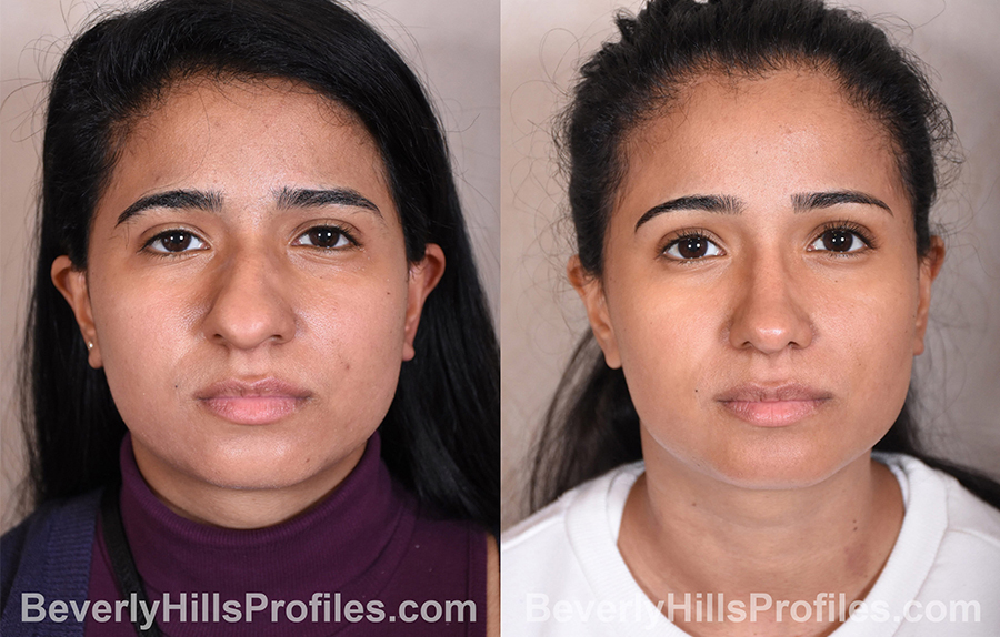 Woman's face, before and after Rhinoplasty treatment, front view, patient 9