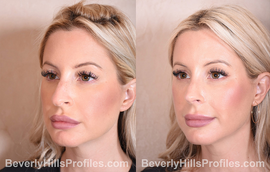 Woman's face, before and after Rhinoplasty treatment, r-side oblique view, patient 111