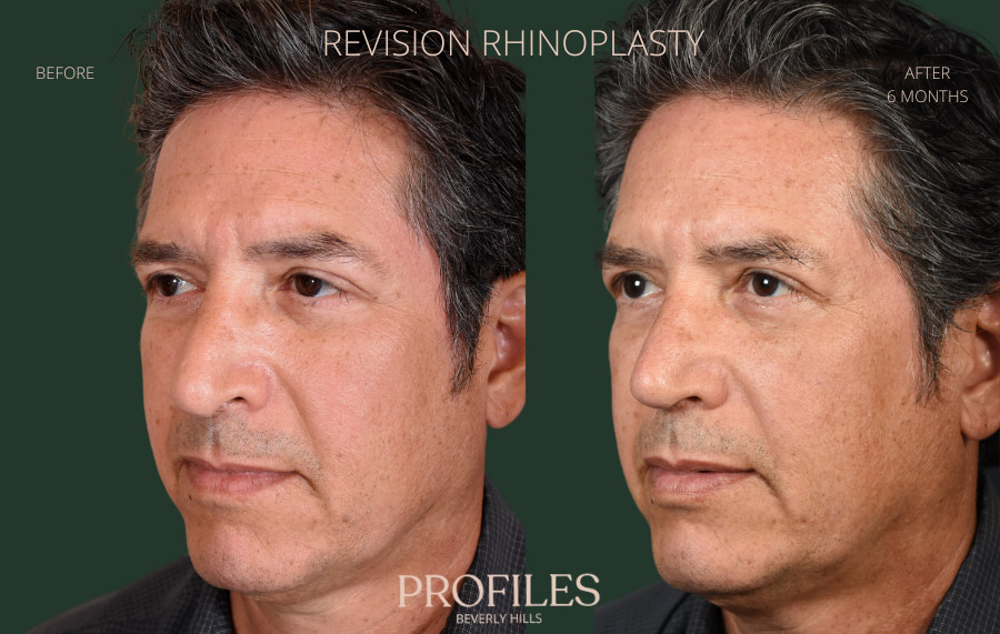 Revision Rhinoplasty Before and After Photo Gallery - l-side oblique view, male patient 42