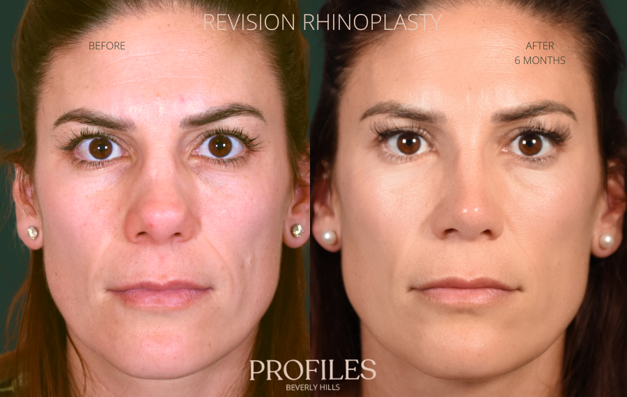 Revision Rhinoplasty Before and After Photo Gallery - front view, female patient 43